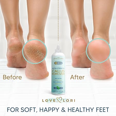 LOVE LORI Callus Remover for Feet (Extra Strength) Foot Callus Remover Gel