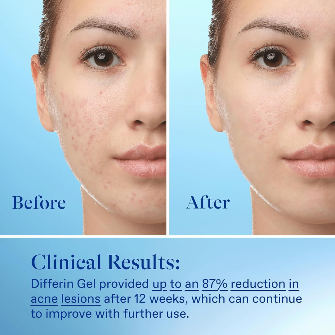Differin Acne Gel Gentle Skin Care for Acne Prone Sensitive Skin, 15g Tube (Packaging May Vary)