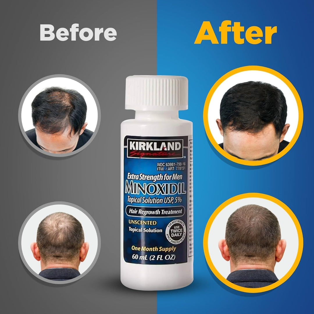 Kirkland Signature Minoxidil 5% Topical Solution for Men – 6 Month Supply, Hair Regrowth Treatment, 6 x 60ml