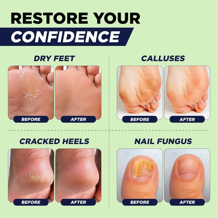 A promotional before-and-after infographic for foot care, showing four panels: dry feet, calluses, cracked heels, and nail fungus. Each panel contains a before/after comparison of a foot or heel, with text labels and a light green background.
