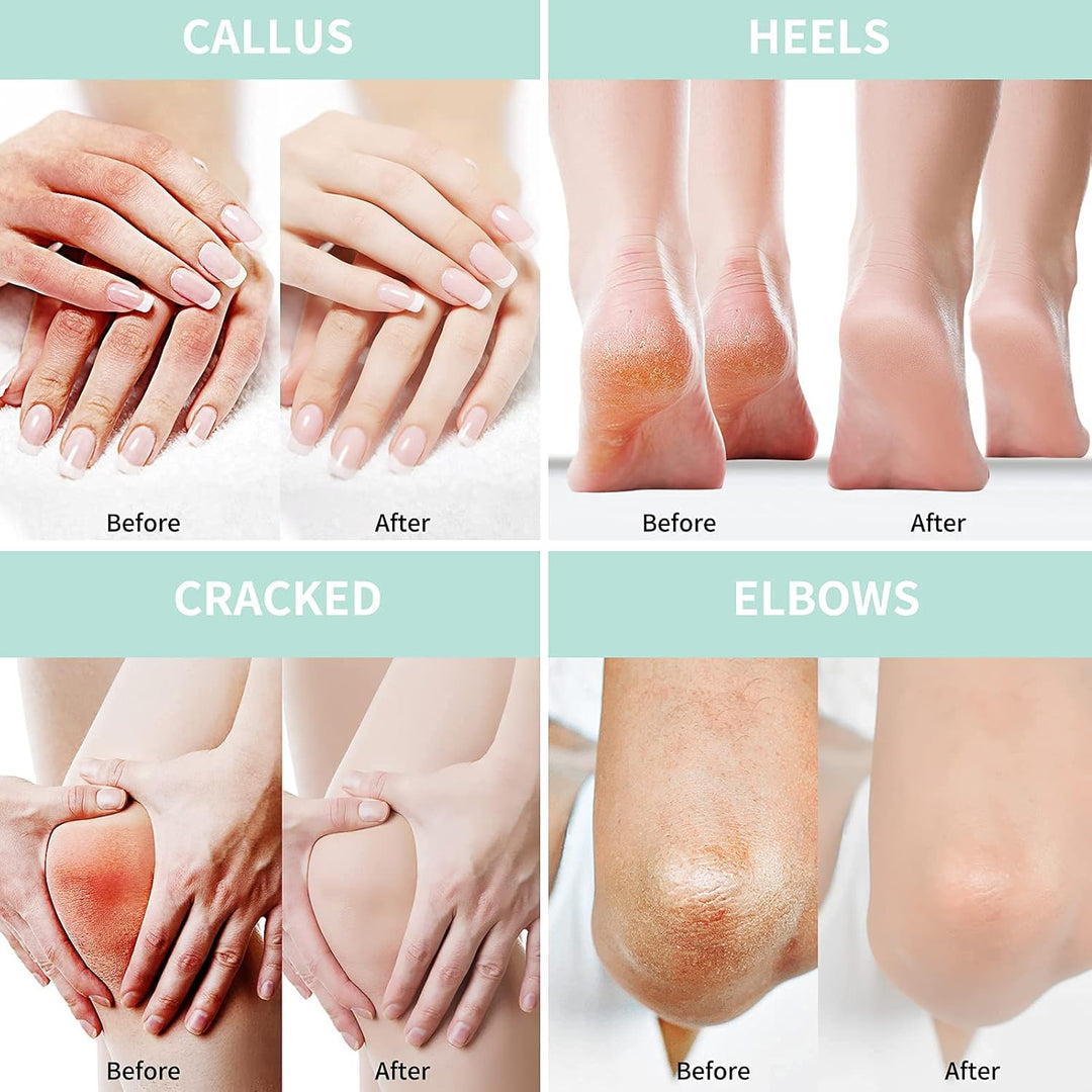 Before and after showing the effects of a skincare product on calluses, heels, cracked skin, and elbows.