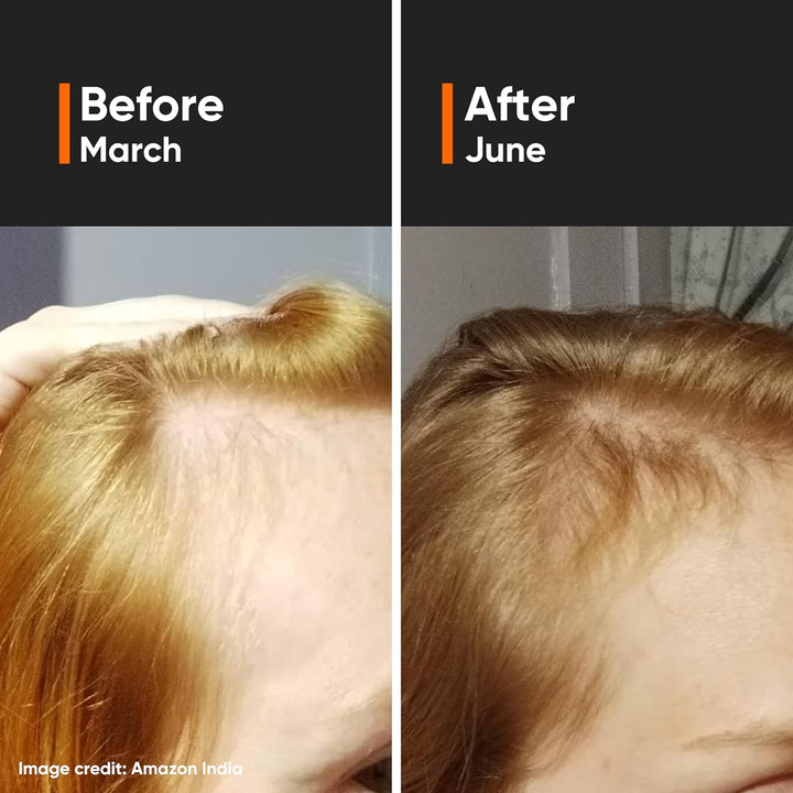 Minimalist Hair Growth Serum 30ml | 18% Actives Redensyl Anagain Procapil Capixyl Baicapil