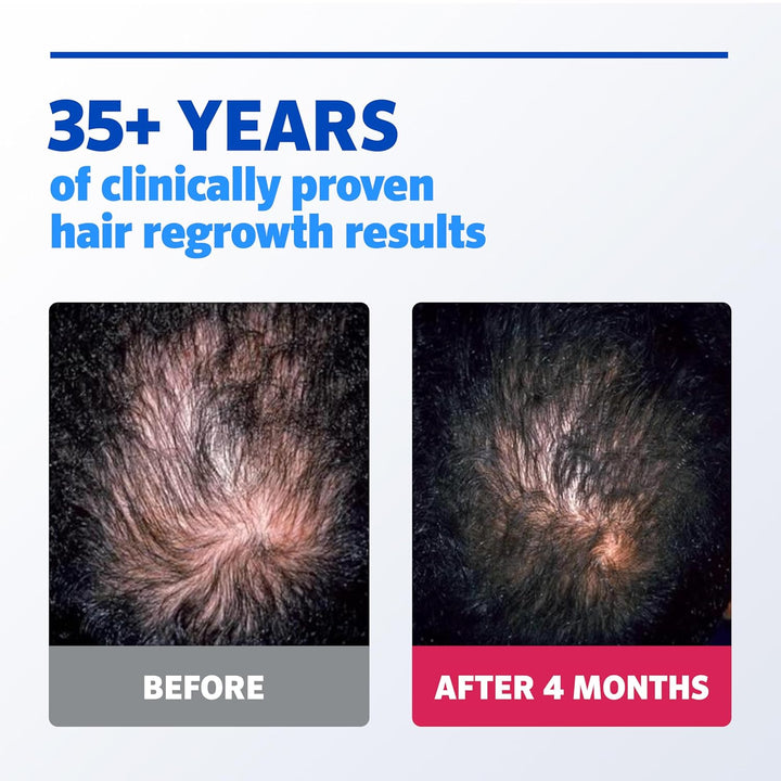 Men’s Rogaine Extra Strength 5% Minoxidil Topical Solution (3 Month Supply)